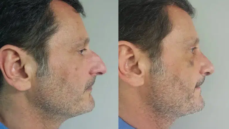 male nose surgery before and after