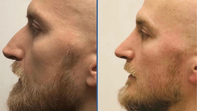 male rhinoplasty before after