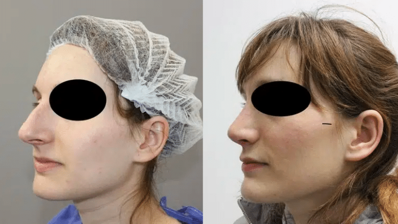 nose surgery before and after