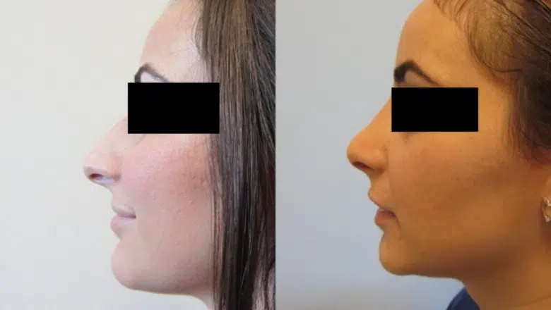 rhinoplasty before after 5