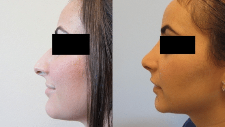 rhinoplasty before after 5