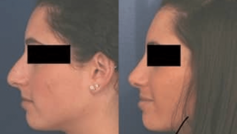 rhinoplasty before after 6