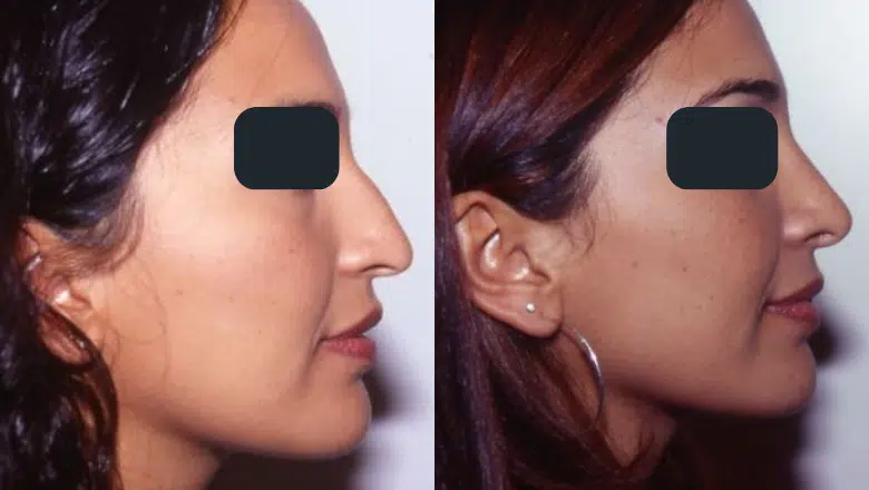 rhinoplasty before after