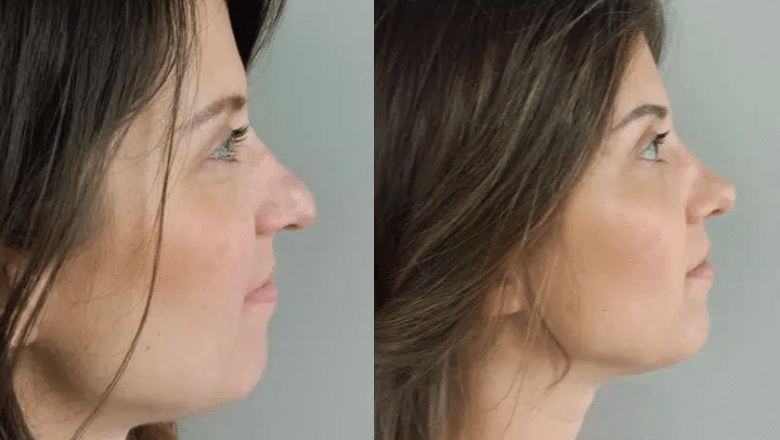 rhinoplasty before and after (1)