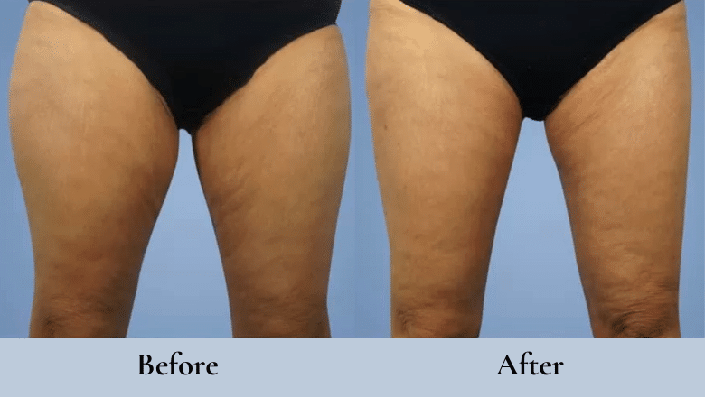 thigh lift before after 2
