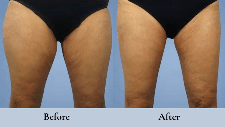 Saggy thighs after online weight loss