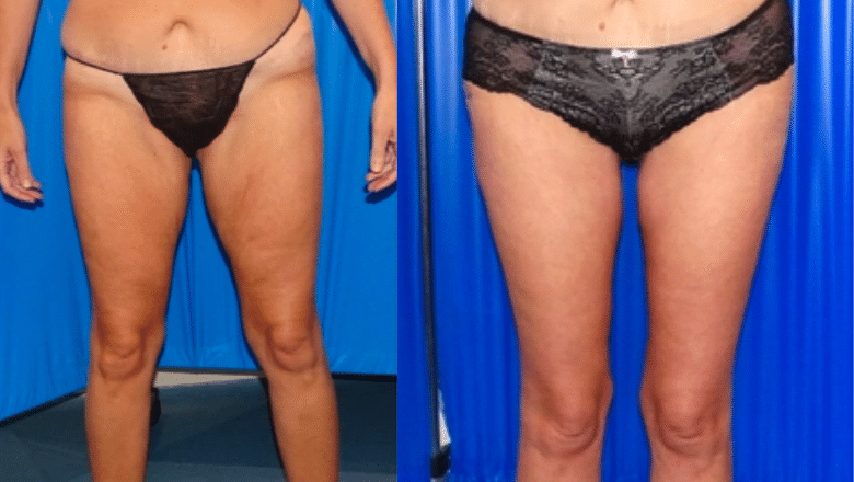 thigh lift before and after photos