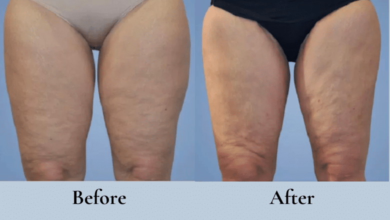 thigh lift surgery before after 2