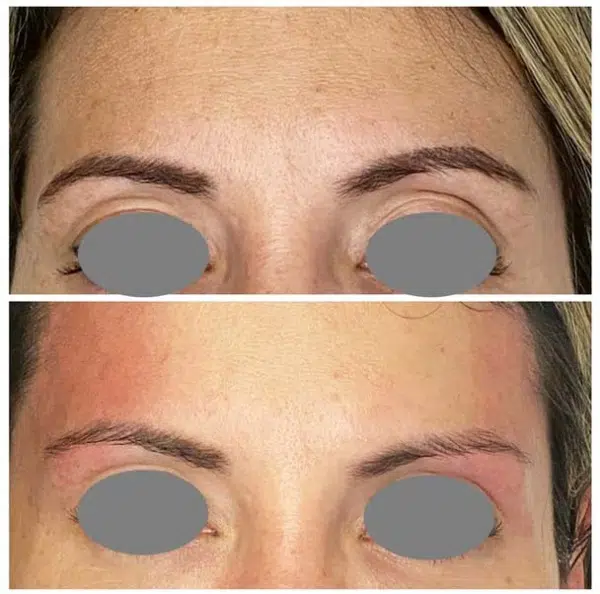 non-surgical fox eye lift