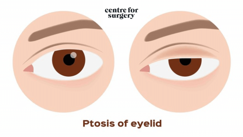 ptosis of the eyelid