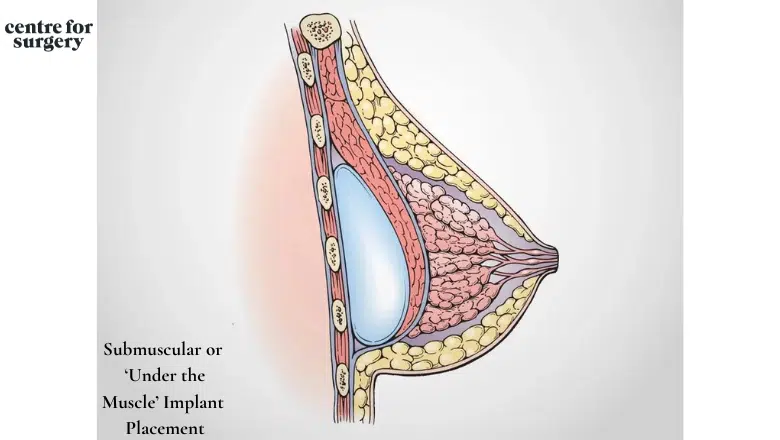 Submuscular or ‘Under the Muscle’ Implant Placement