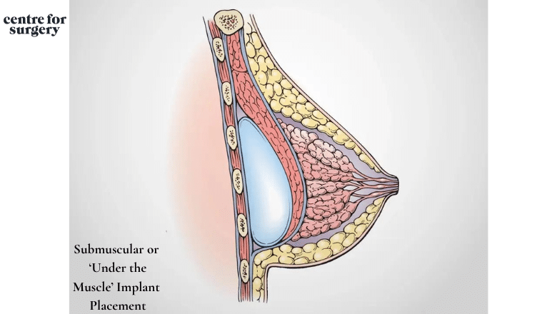 Submuscular or ‘Under the Muscle’ Implant Placement