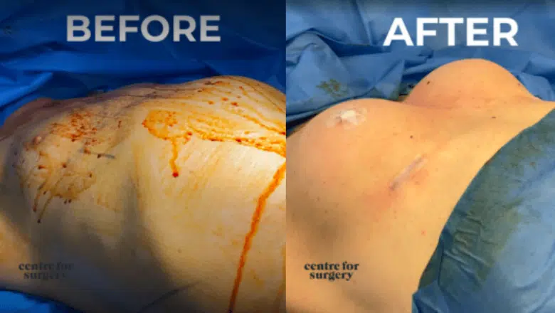 Trans Breast Surgery Before After on table view