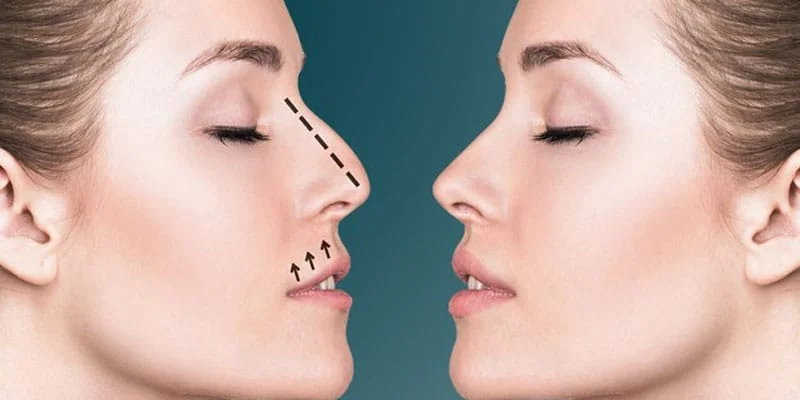 what conditions can rhinoplasty correct