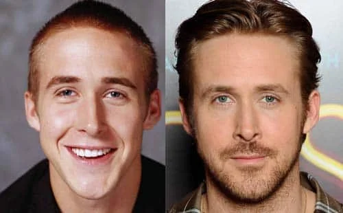 ryan gosling nose job