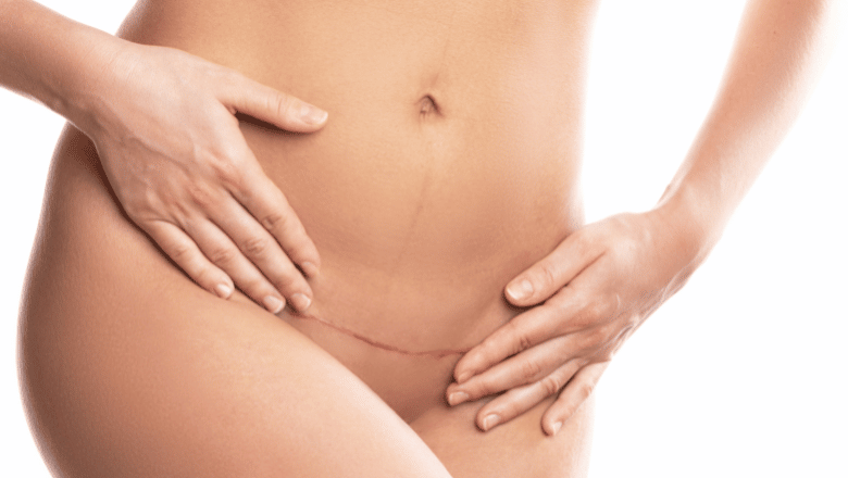 how to minimise scars after tummy tuck surgery