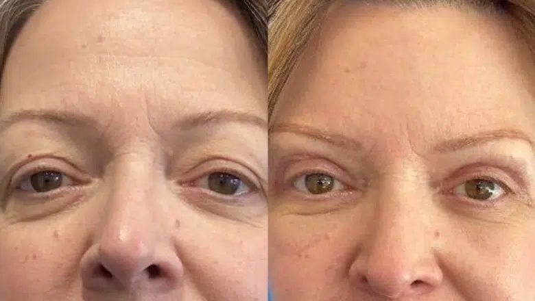 Upper eyelid before and after 1