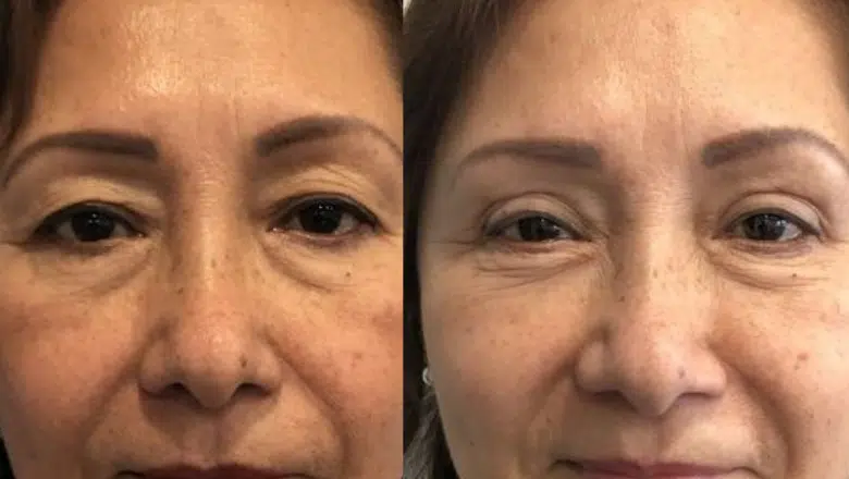 Upper eyelid B&A 3