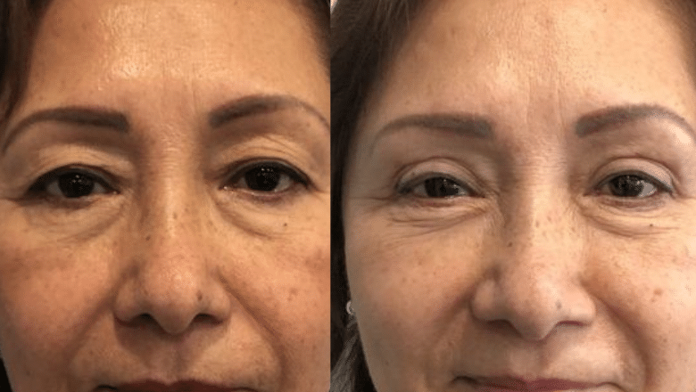 Upper eyelid surgery B&A 3