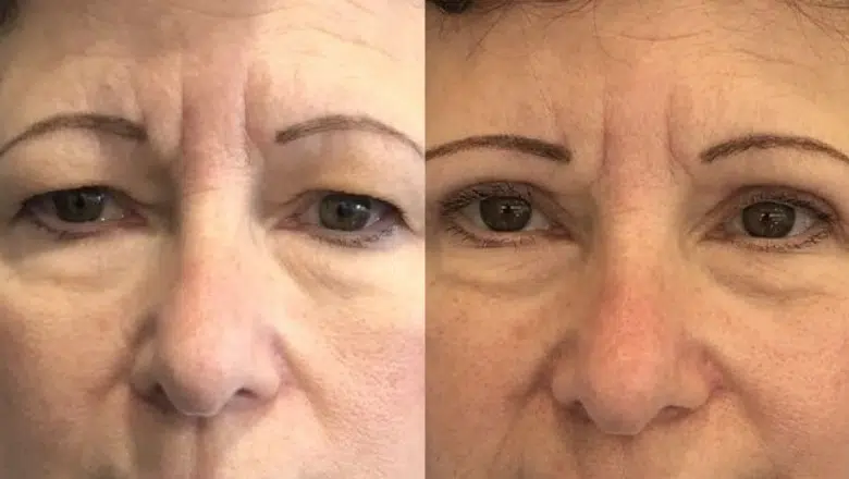 Upper eyelid before and after 2