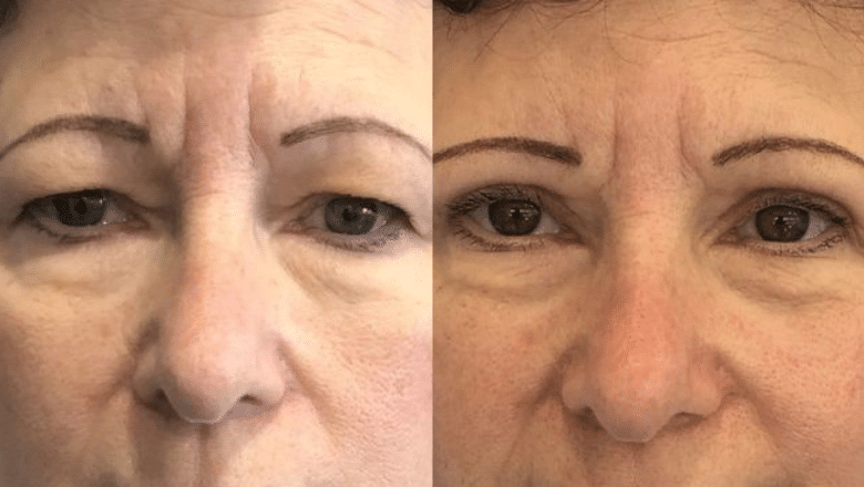 Upper eyelid surgery before and after
