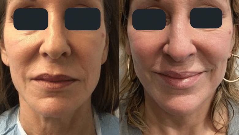 mini facelift before and after 1