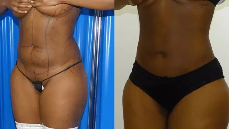 stomach liposuction