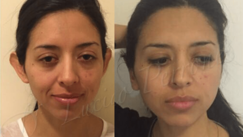 otoplasty before after 5 