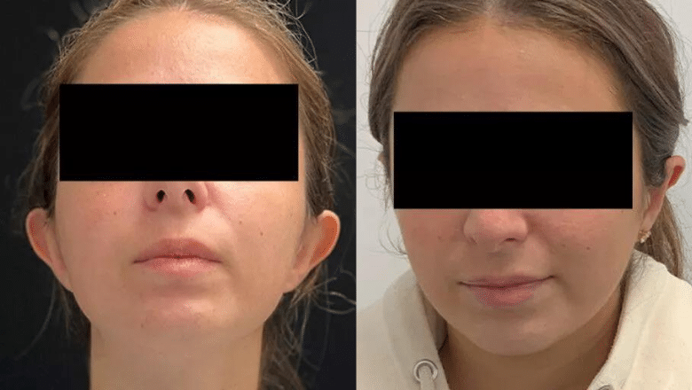 otoplasty before after 6