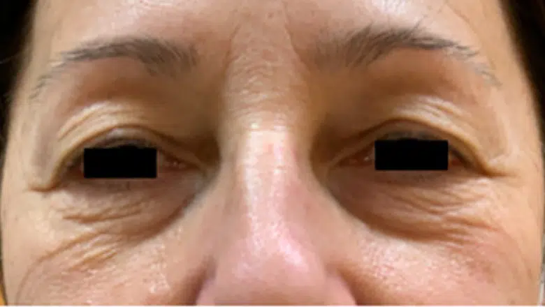 blepharoplasty before photo 1