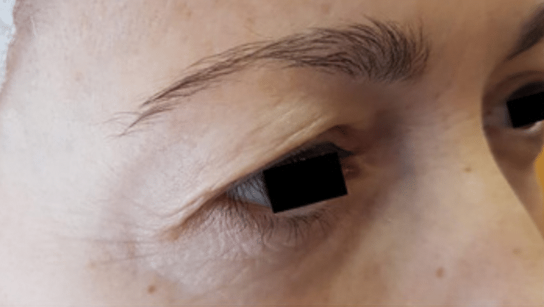 upper eyelid surgery side view before 1