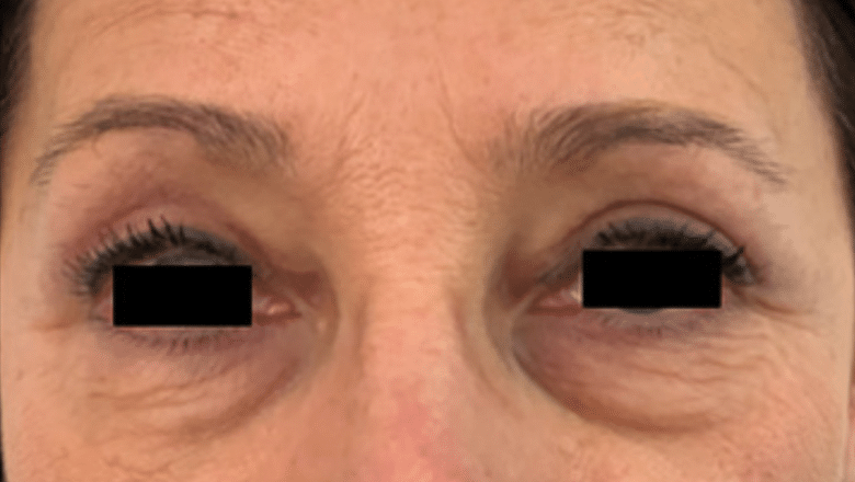 blepharoplasty after photo 1