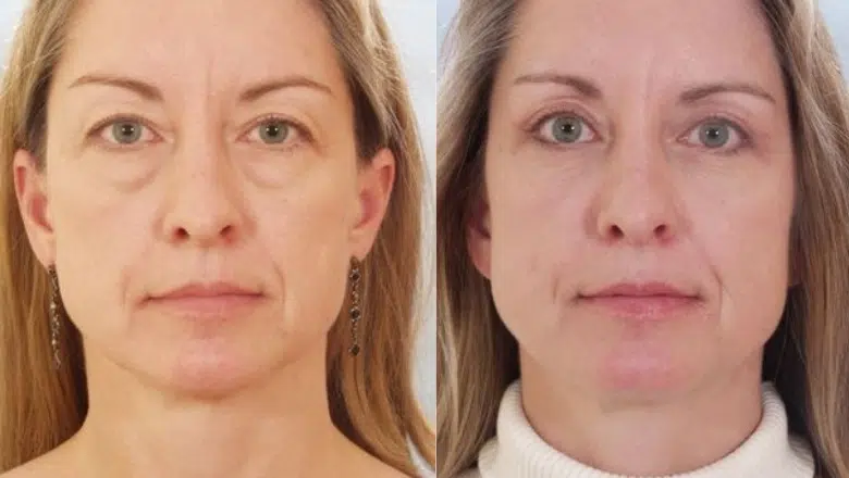 Blepharoplasty before after 5