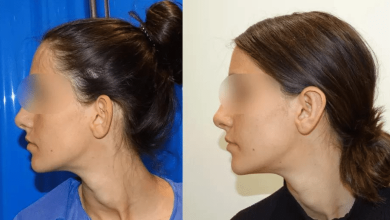 Otoplasty Before & After Photos