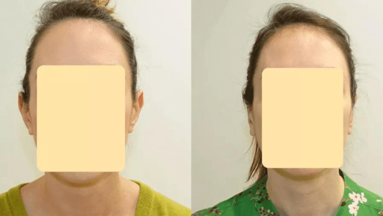 Otoplasty surgery before and after 2