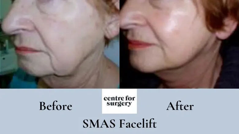 SMAS-facelift-before-and-after-7.png.webp?format=webp&nv=212368fc-2000-40d1-9026-c0f94abda644