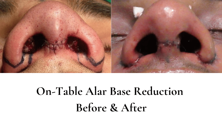 alar-base-reduction-before-and-after.png?format=webp&nv=212368fc-2000-40d1-9026-c0f94abda644