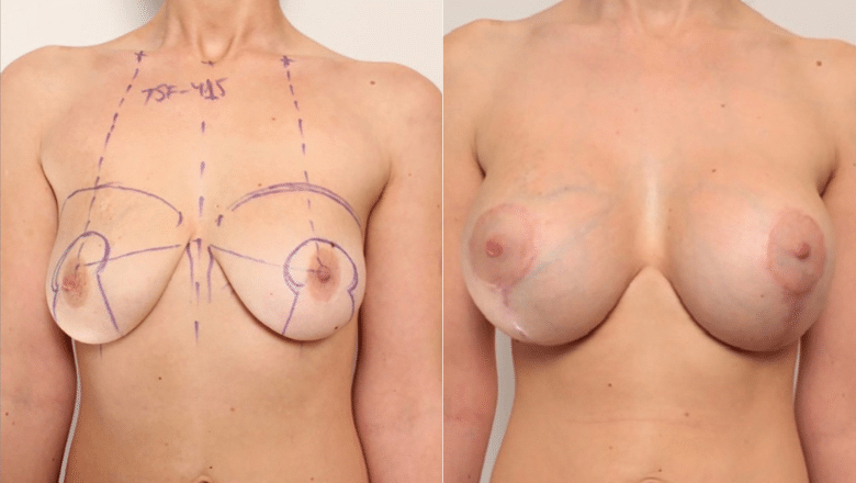 breast lift with implants before and after