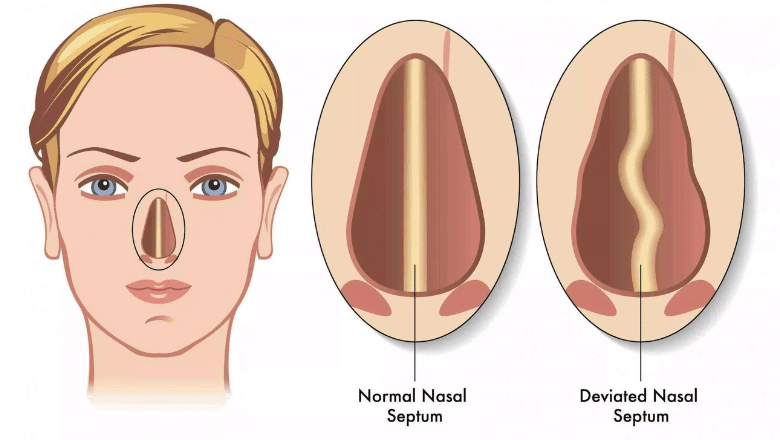 broken nose surgery