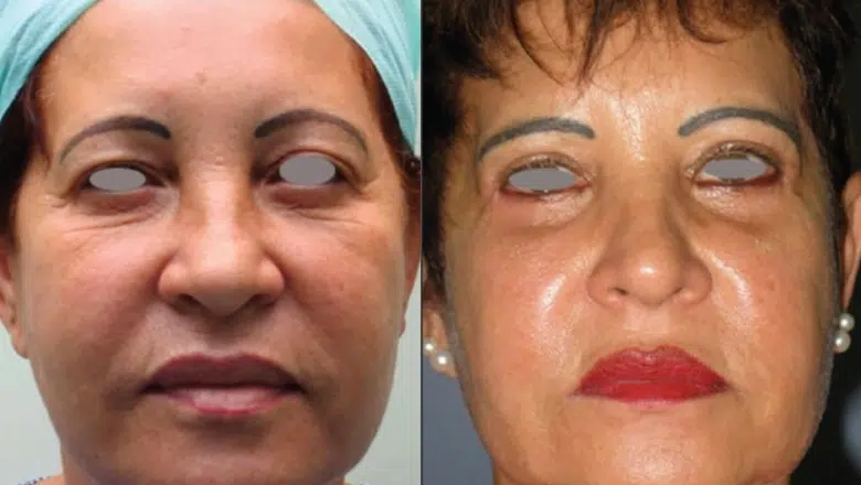 upper and lower eyelid before and after 4