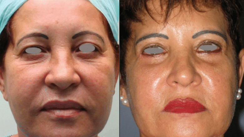 eyelid surgery before and after