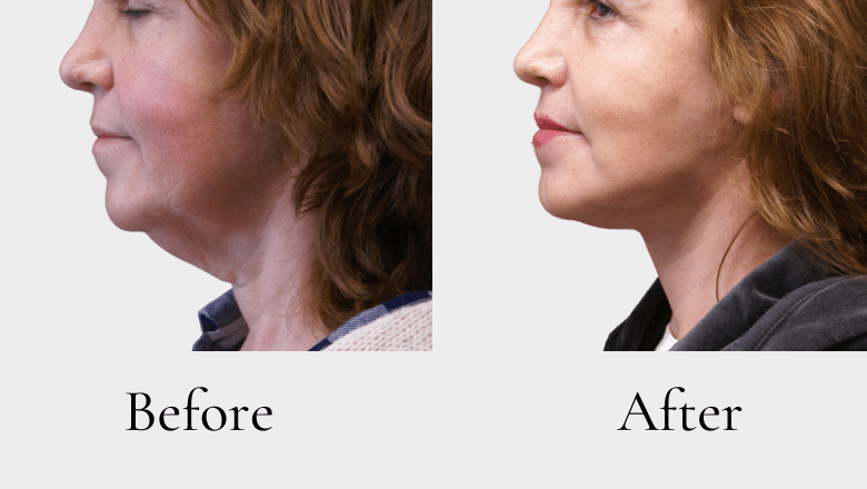 facelift and neck lift before after