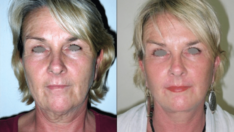 facelift before after 3