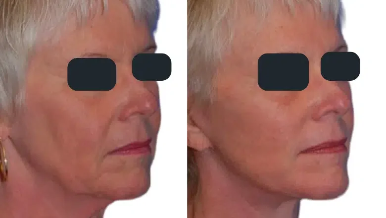 facelift-necklift-before-after.png.webp?format=webp&nv=212368fc-2000-40d1-9026-c0f94abda644