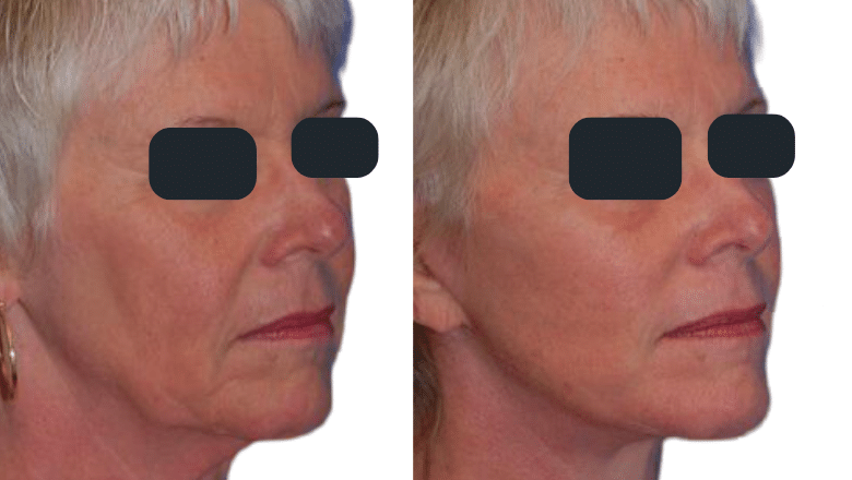 facelift necklift before after