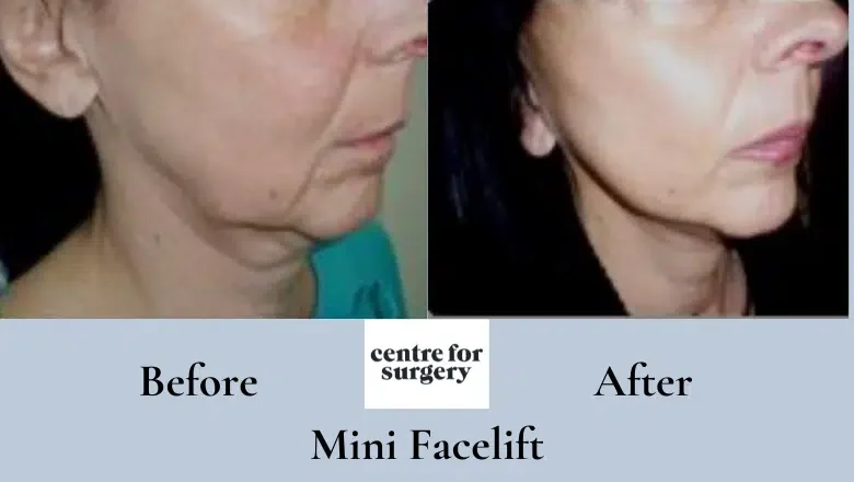 mini-facelift-before-and-after-7.png.webp?format=webp&nv=212368fc-2000-40d1-9026-c0f94abda644