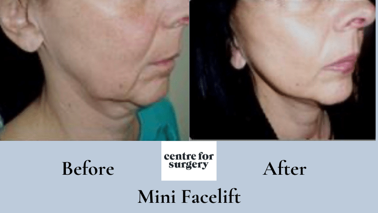 mini facelift before and after 7