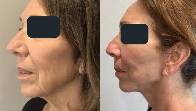 mini-facelift-surgery-before-and-after-3-1.png.webp?format=webp&nv=212368fc-2000-40d1-9026-c0f94abda644