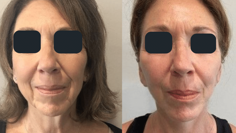 mini facelift surgery before and after 3