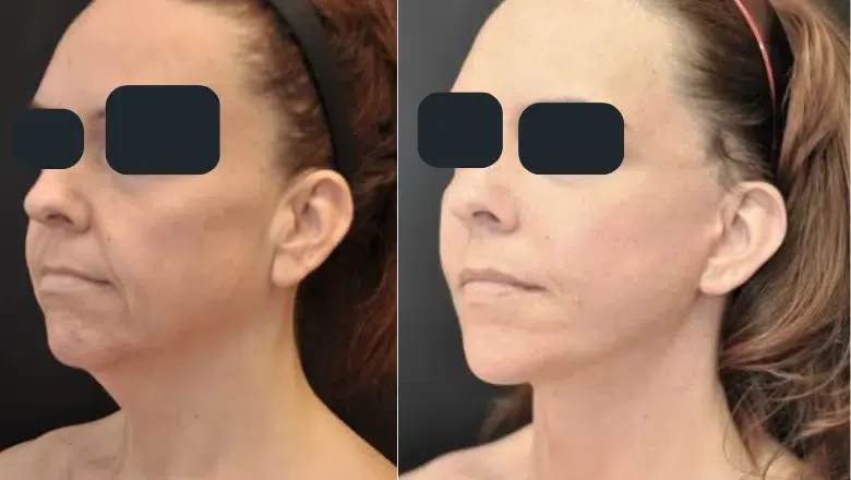 neck-lift-surgery-before-and-after-1-1.png.webp?format=webp&nv=212368fc-2000-40d1-9026-c0f94abda644